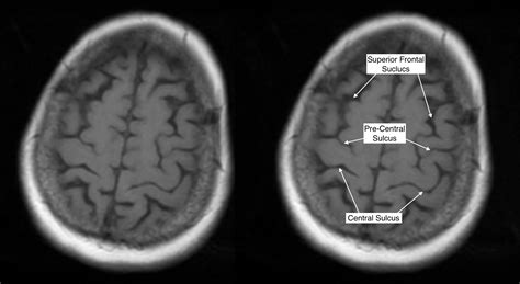 Postcentral Gyrus Mri