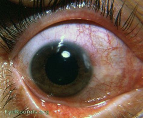 Corneal Marginal Ulcer