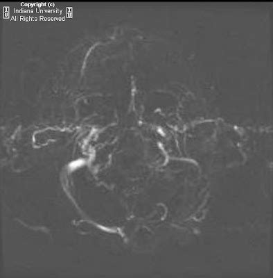 Neuroradiology On the Net: Rabies encephalitis