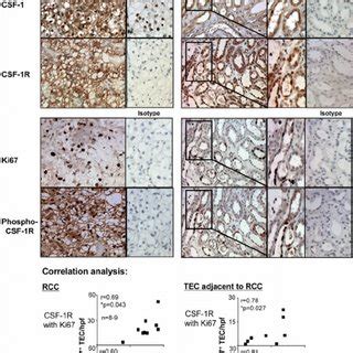 Csf R And Csf Expression On Rcc And Tec That Are Adjacent To Rcc