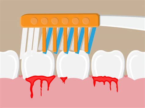 Causes Of Bleeding Gums And How You Can Treat Them D Dental