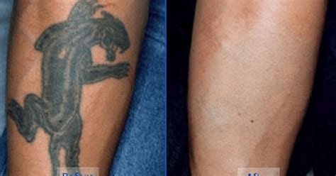 5 Natural Tattoo Removal Remedies You Can Try At Home Pulse Nigeria