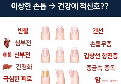 손톱으로 보는 건강상태 네이버 블로그