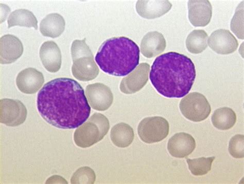 Amgen Reports Positive Data From Blincyto Study In Leukaemia Patients