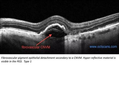 Choroidal Neovascular Membranes Cnvm Ppt Free Download