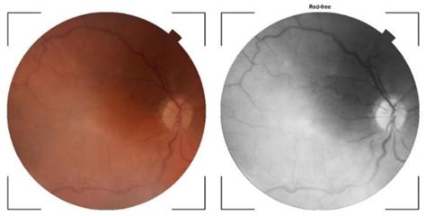 Figure 1 From Retinal Angiomatous Proliferation Case Report Semantic