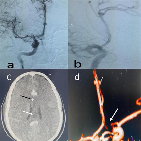 Digital Subtraction Angiography A Ap View And B Oblique View Of Download Scientific Diagram