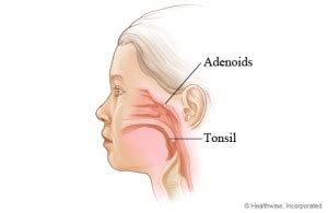 Adenoidectomy Alleviates Obstruction of the Airway - ENT Clinic Sydney