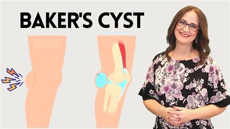 128 Four Easy Ways To Treating A Baker S Cyst Popliteal Cyst YouTube