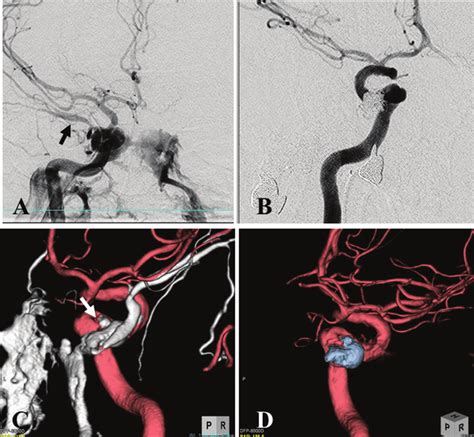 Right Internal Carotid Angiography 3 Weeks After Thrombectomy Shows Download Scientific Diagram