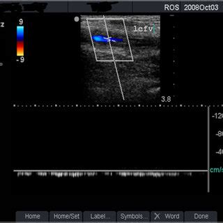 Normal venous flow (grade 1). Duplex scan showing normal blood flow ...