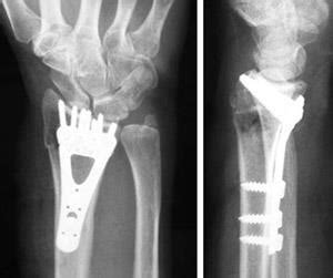 Fracturas Distales Del Radio Mu Eca Quebrada Distal Radius Fractures