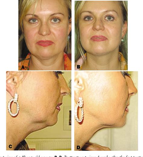 List 95 Pictures Lipotropic Injections Before And After Photos Stunning