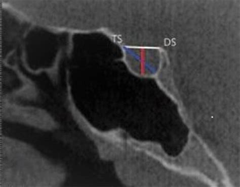 Normal sella turcica. Morphology and reference lines used to measure... | Download Scientific ...