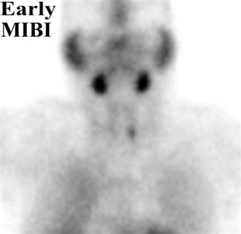 Radionuclide Imaging Of The Parathyroid Glands Patterns Pearls And