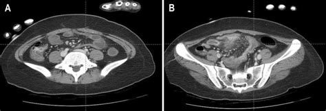 A B Abdominal Pelvic Computed Tomography Scan Demonstrated Active Download Scientific