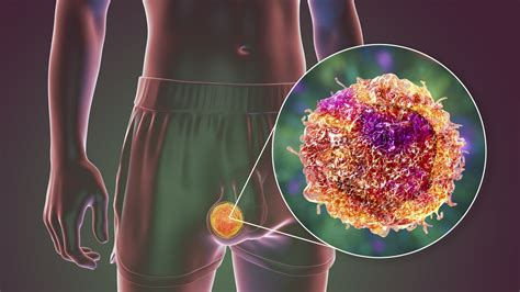 Hodenkrebs Vorsorge Behandlung Risikofaktoren