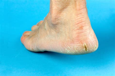 Treatment And Prevention For Cracked Dry Heels Heel Fissure Footfiles