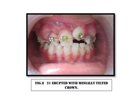 Orthodontic Extrusion Of Impacted Tooth Ppt