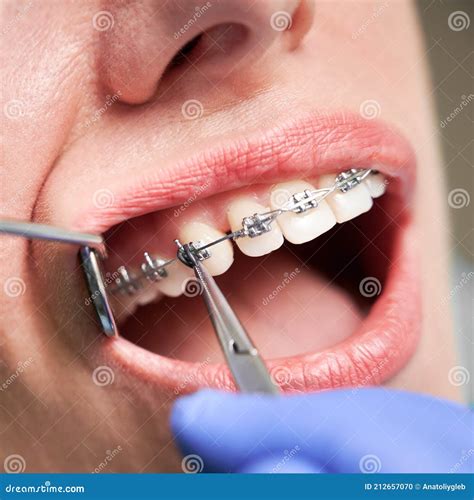 Dentist Placing Braces On Female Patient Teeth Stock Photo Image Of