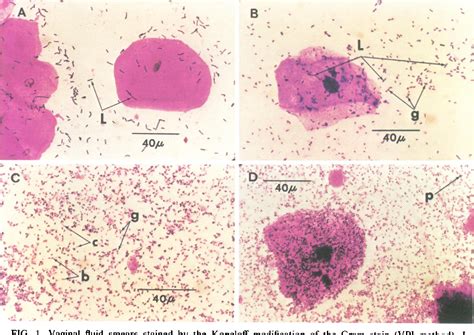 Figure From Diagnosis Of Bacterial Vaginosis By Direct Gram Stain Of