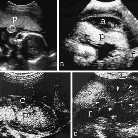 Pdf Placental Abruption