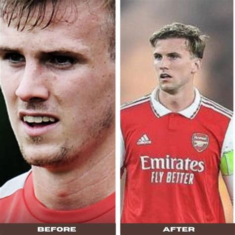 Rob Holding Hair Transplant And Heres What We Know About It