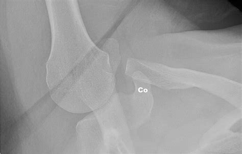 Stryker Notch View Of The Right Shoulder In A 24 Year Old Male Shows