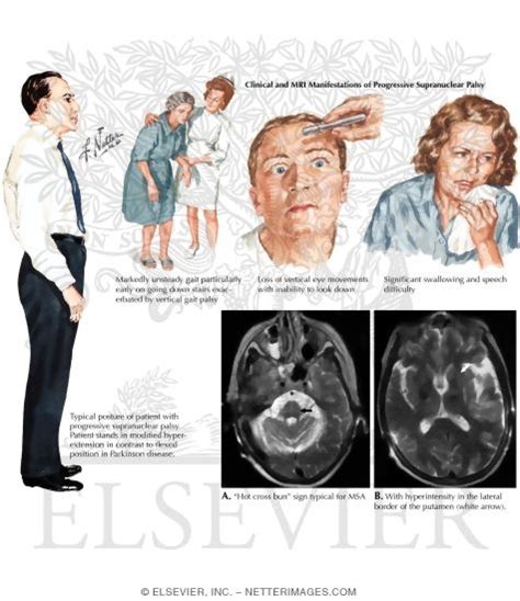 Progressive Supranuclear Palsy