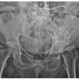 Plain Radiograph Of The Pelvis 18 Months After Vascular Intervention