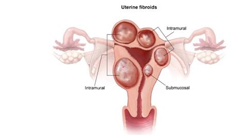 USMLE S2CK Uworld Gynae Case 2 YouTube