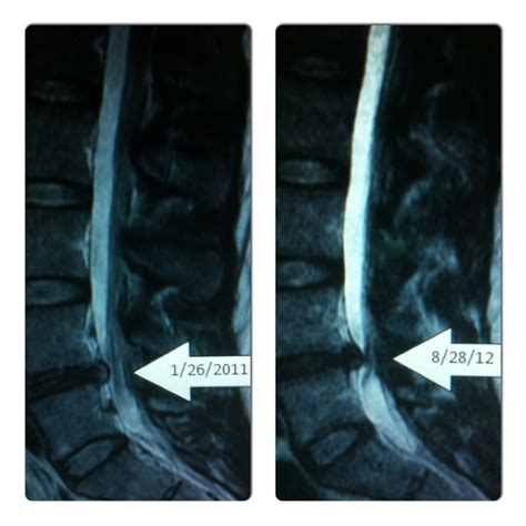 MRI of Bulging L4/L5 disc on nerve. | illness + pain. | Pinterest