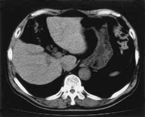 Figure 1 From Nonparasitic Solitary Giant Hepatic Cyst Causing