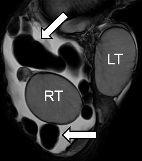 Fibrous Pseudotumor Radiographics