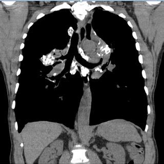 Frontal Chest Radiograph Of Year Old Male With Asbestosis