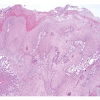 Microscopic aspects supporting diagnosis of verrucous carcinoma. Note... | Download Scientific ...