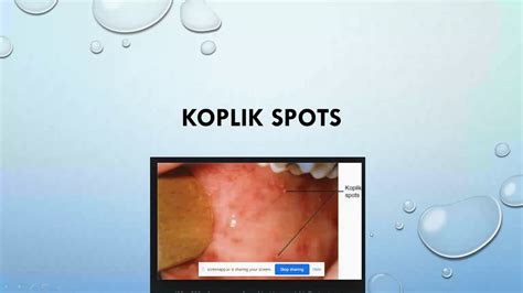 Koplik Spots Measles Youtube