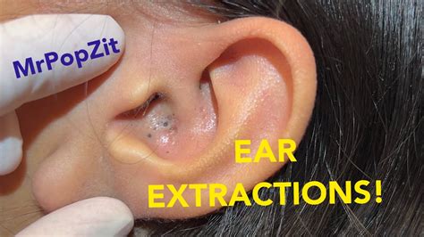 Ear Extractions Must See Giant Ear Blackheads Extracted Youtube