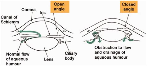 Acute Angle Closure Glaucoma