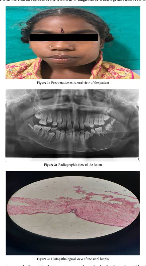 Figure 1 From Ameloblastic Fibro Odontoma Associated With Odontogenic