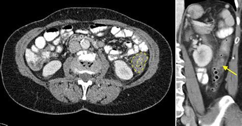 Acute Diverticulitis Ct Radiology At St Vincents University Hospital