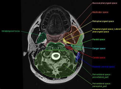 Deep Face And Neck Spaces Delineated On A Mri Temporal Space Parotid Space Mri Anatomy