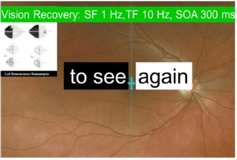 Testing of a subject with left homonymous hemianopsia visual field... | Download Scientific Diagram