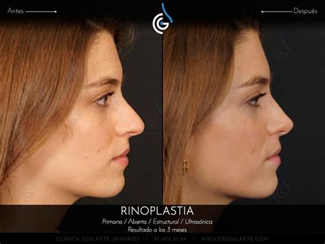 Rinoplastia Ultrasonica Madrid Operación De Nariz Con Ultrasonidos