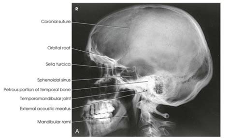 Skull Positioning Flashcards Quizlet