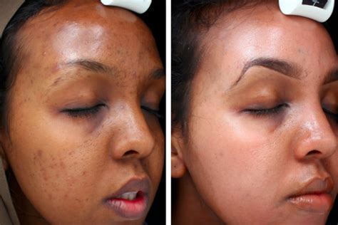 Hyperpigmentation Treatment Eudelo Dermatology Skin Wellbeing