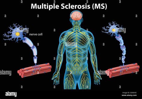 Menschliche Anatomie Der Multiplen Sklerose Stock Vektorgrafik Alamy