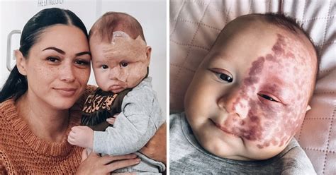 Une Maman A Fait Enlever Une Tache De Naissance Sur Le Visage De Son