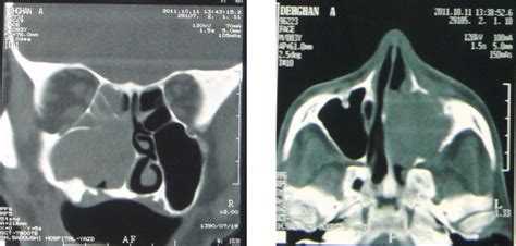 A, Coronal and B, Axial computerized tomographs (CT) | Download ... 