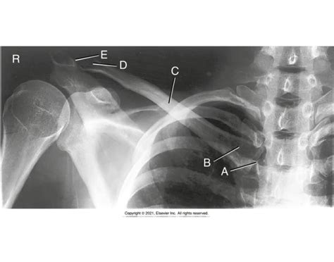 Radiograph Of Ap Clavicle — Printable Worksheet